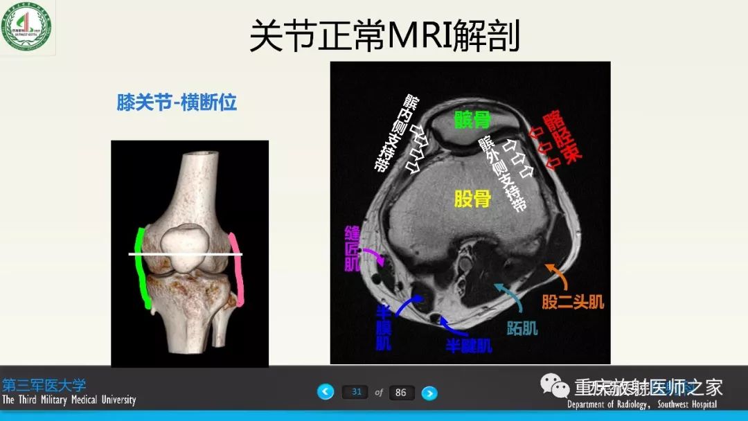 影像PPT - 【PPT】膝关节韧带MRI诊断要点-31
