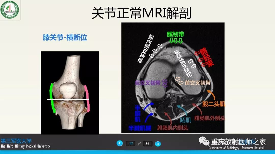 影像PPT - 【PPT】膝关节韧带MRI诊断要点-32