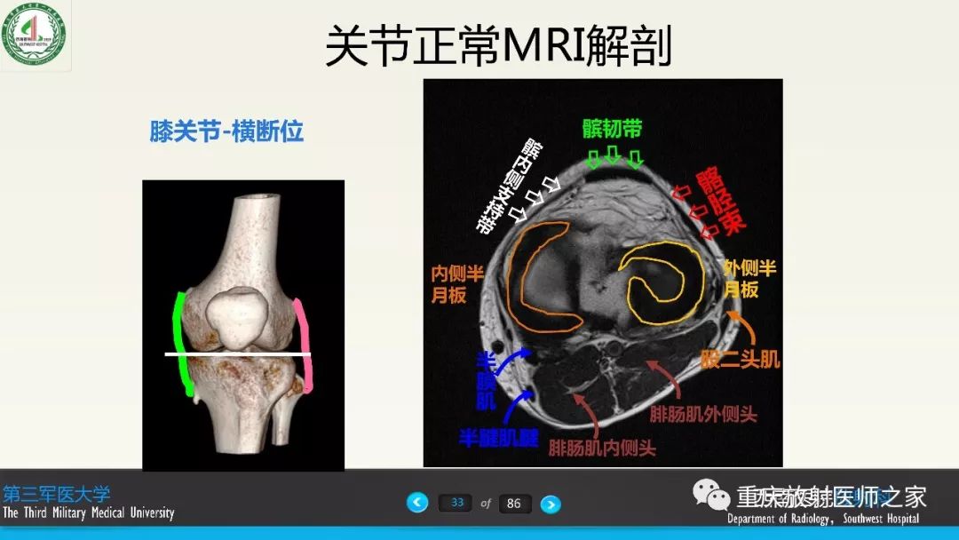 影像PPT - 【PPT】膝关节韧带MRI诊断要点-33