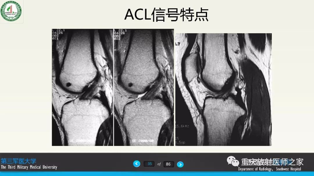 影像PPT - 【PPT】膝关节韧带MRI诊断要点-35