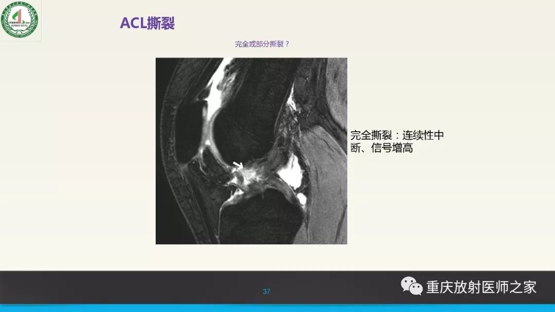 影像PPT - 【PPT】膝关节韧带MRI诊断要点-37