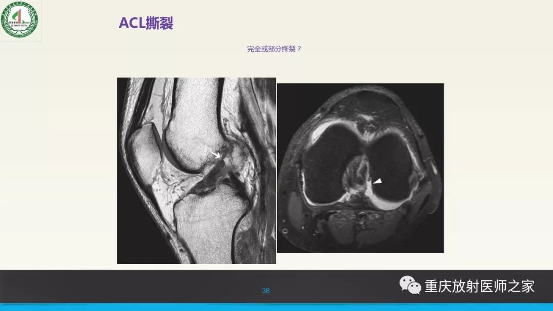 影像PPT - 【PPT】膝关节韧带MRI诊断要点-38