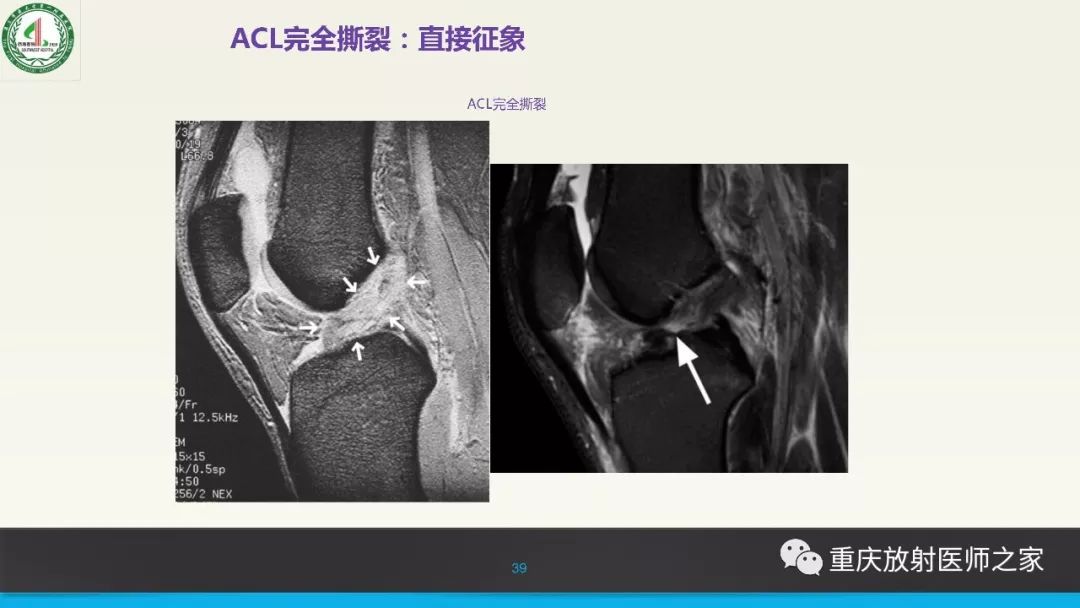 影像PPT - 【PPT】膝关节韧带MRI诊断要点-39