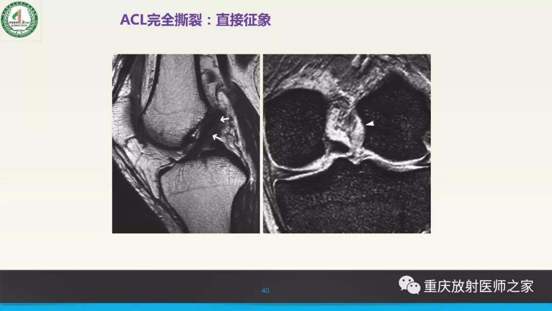 影像PPT - 【PPT】膝关节韧带MRI诊断要点-40