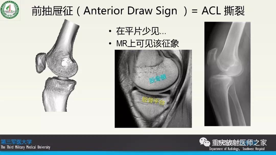 影像PPT - 【PPT】膝关节韧带MRI诊断要点-42