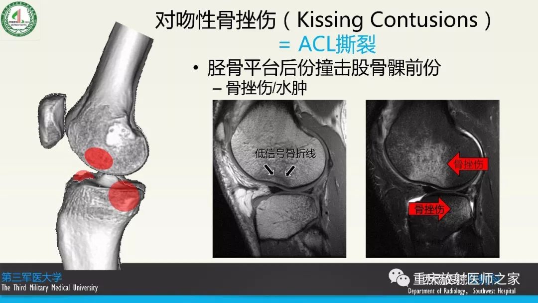影像PPT - 【PPT】膝关节韧带MRI诊断要点-43