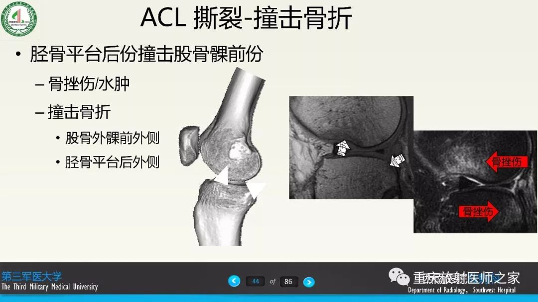影像PPT - 【PPT】膝关节韧带MRI诊断要点-44