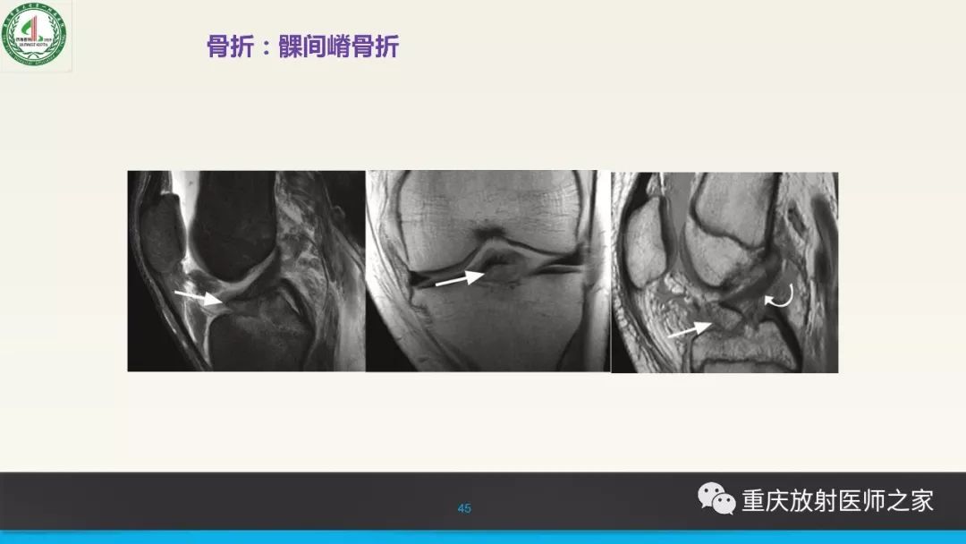 影像PPT - 【PPT】膝关节韧带MRI诊断要点-45