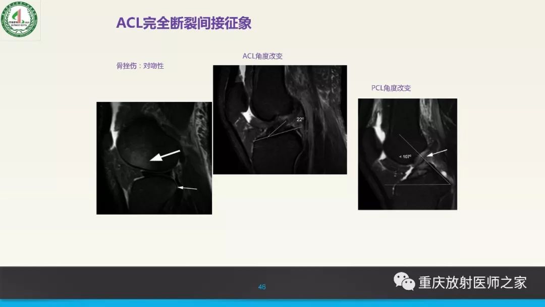 影像PPT - 【PPT】膝关节韧带MRI诊断要点-46