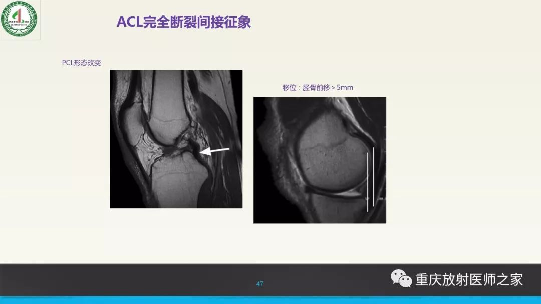 影像PPT - 【PPT】膝关节韧带MRI诊断要点-47