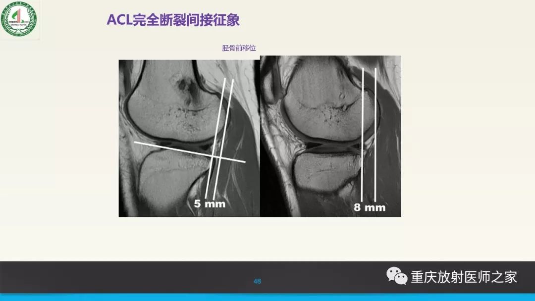 影像PPT - 【PPT】膝关节韧带MRI诊断要点-48