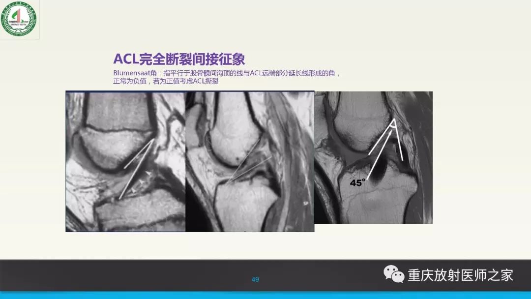 影像PPT - 【PPT】膝关节韧带MRI诊断要点-49