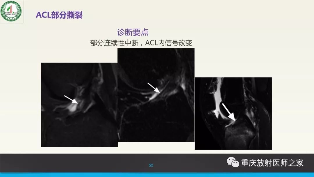影像PPT - 【PPT】膝关节韧带MRI诊断要点-50