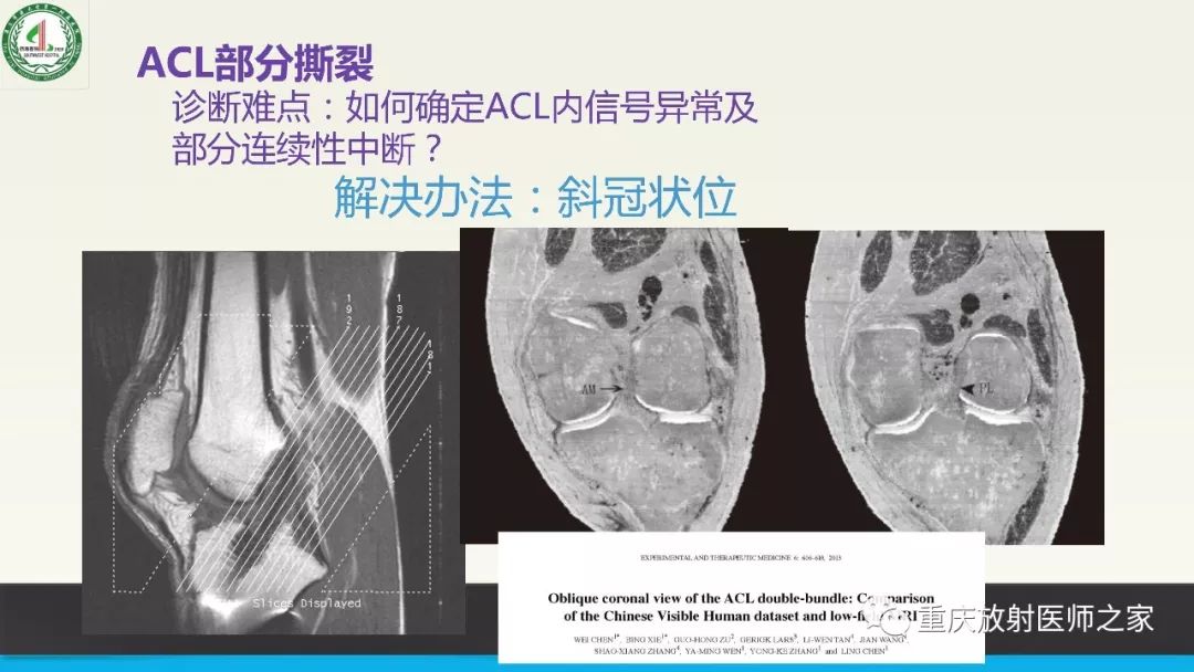 影像PPT - 【PPT】膝关节韧带MRI诊断要点-51