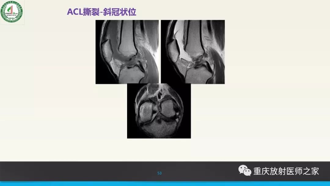 影像PPT - 【PPT】膝关节韧带MRI诊断要点-53