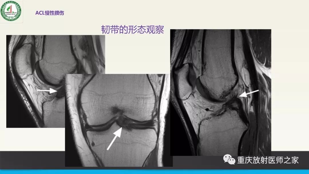 影像PPT - 【PPT】膝关节韧带MRI诊断要点-56