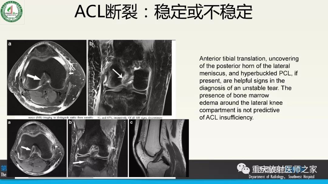 影像PPT - 【PPT】膝关节韧带MRI诊断要点-58