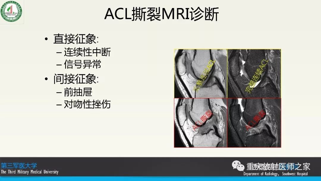 影像PPT - 【PPT】膝关节韧带MRI诊断要点-59