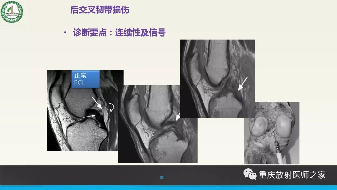 影像PPT - 【PPT】膝关节韧带MRI诊断要点-60