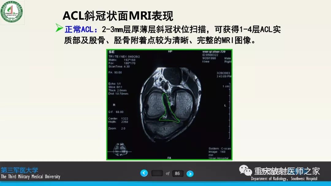 影像PPT - 【PPT】膝关节韧带MRI诊断要点-61