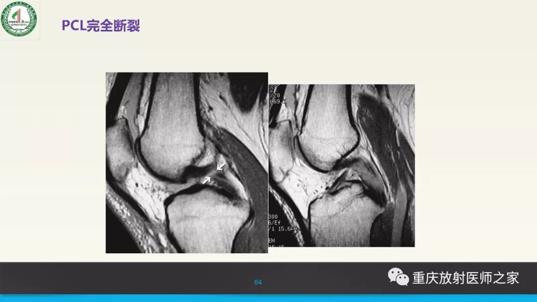 影像PPT - 【PPT】膝关节韧带MRI诊断要点-64