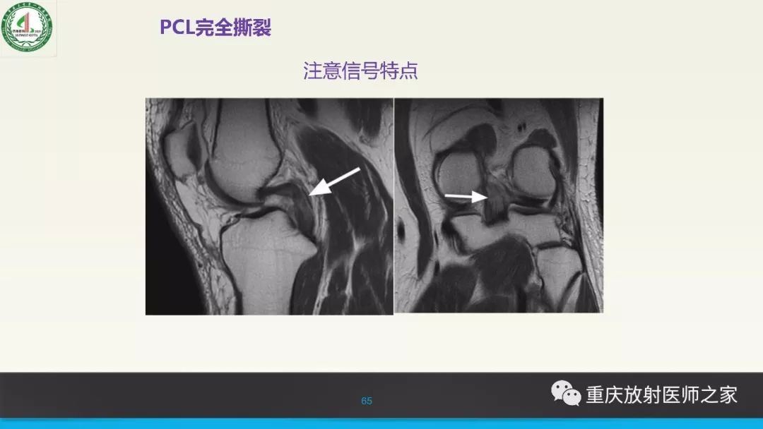 影像PPT - 【PPT】膝关节韧带MRI诊断要点-65