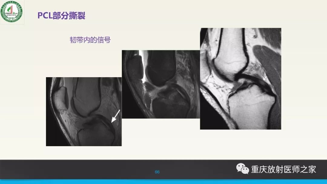 影像PPT - 【PPT】膝关节韧带MRI诊断要点-66