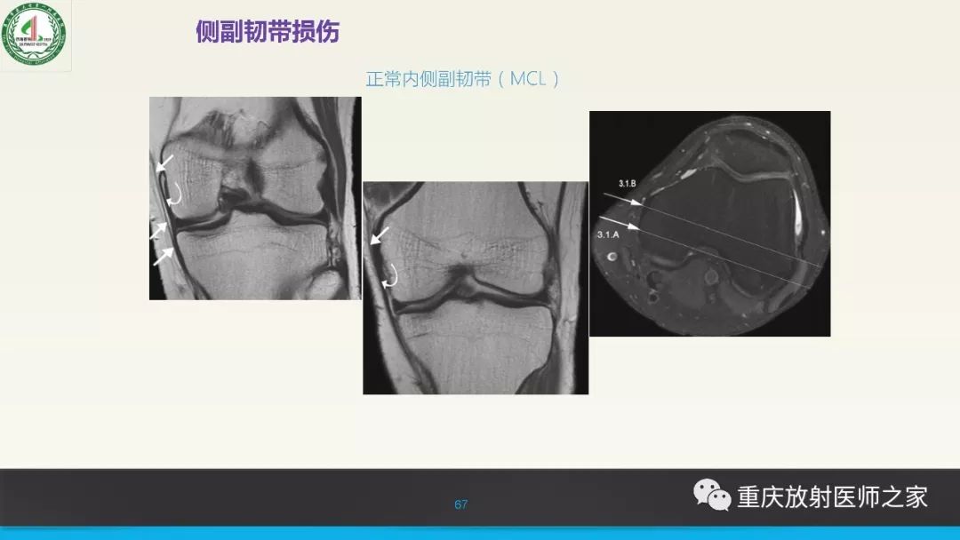 影像PPT - 【PPT】膝关节韧带MRI诊断要点-67