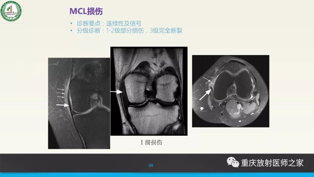 影像PPT - 【PPT】膝关节韧带MRI诊断要点-68