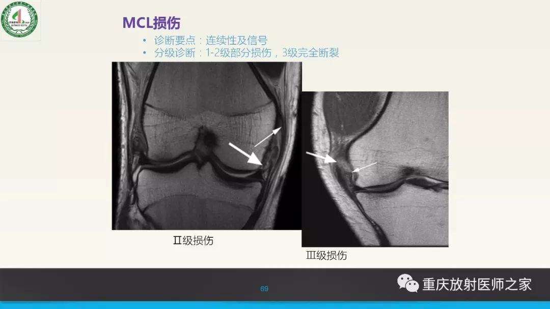 影像PPT - 【PPT】膝关节韧带MRI诊断要点-69