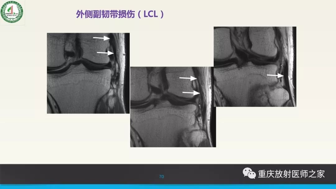 影像PPT - 【PPT】膝关节韧带MRI诊断要点-70