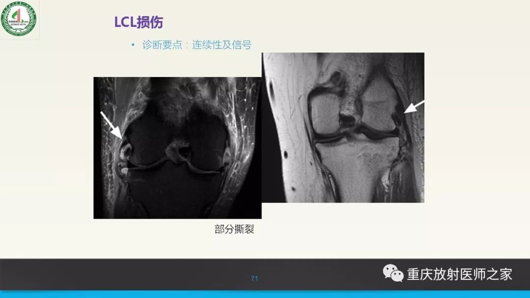 影像PPT - 【PPT】膝关节韧带MRI诊断要点-71