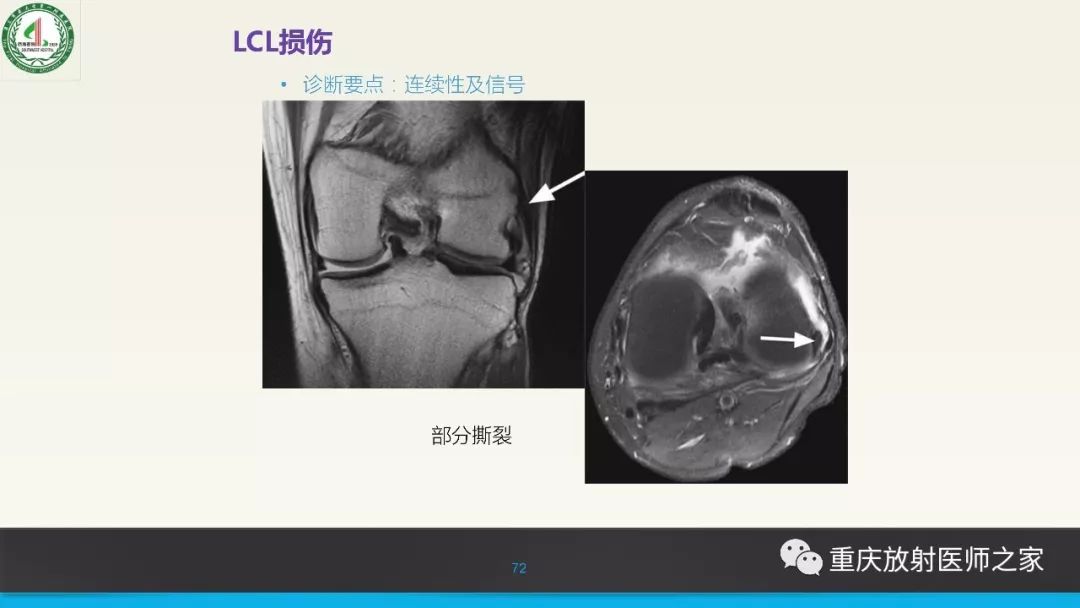 影像PPT - 【PPT】膝关节韧带MRI诊断要点-72