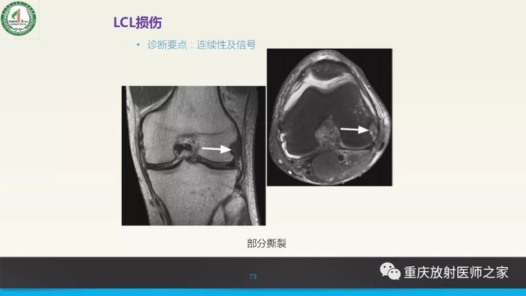 影像PPT - 【PPT】膝关节韧带MRI诊断要点-73