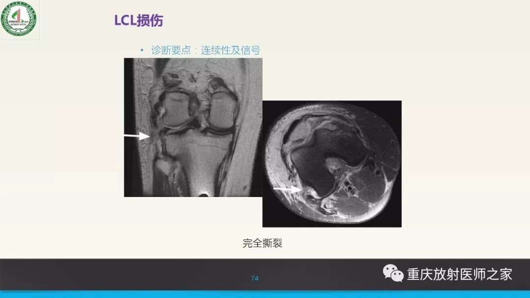 影像PPT - 【PPT】膝关节韧带MRI诊断要点-74