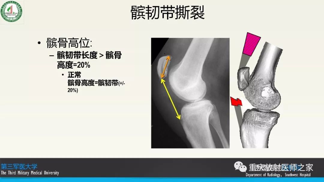 影像PPT - 【PPT】膝关节韧带MRI诊断要点-76