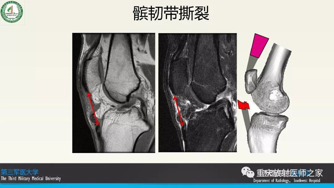 影像PPT - 【PPT】膝关节韧带MRI诊断要点-77