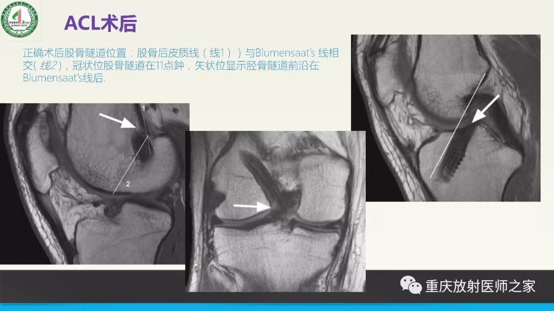 影像PPT - 【PPT】膝关节韧带MRI诊断要点-79