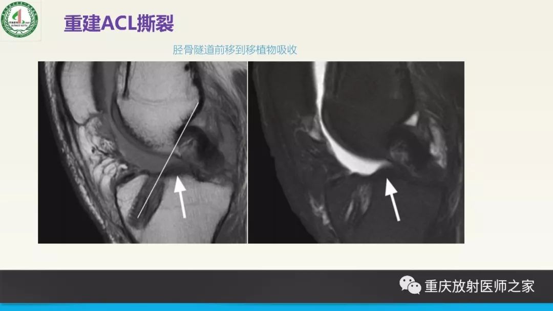 影像PPT - 【PPT】膝关节韧带MRI诊断要点-80
