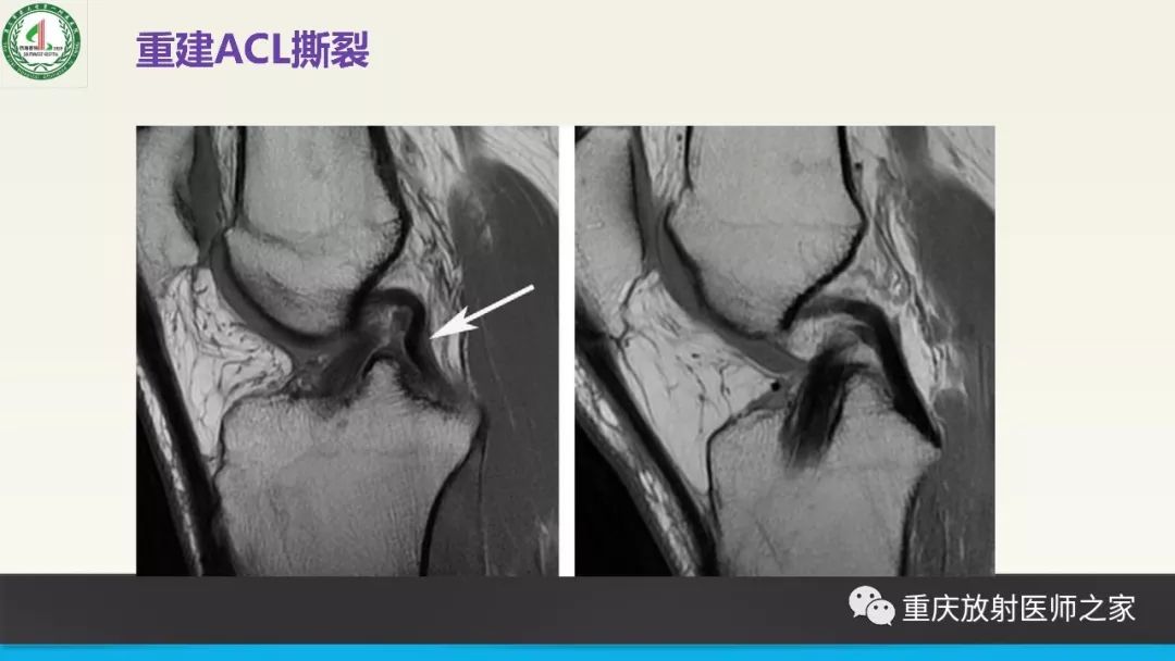 影像PPT - 【PPT】膝关节韧带MRI诊断要点-81
