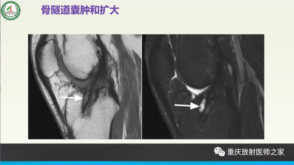 影像PPT - 【PPT】膝关节韧带MRI诊断要点-82