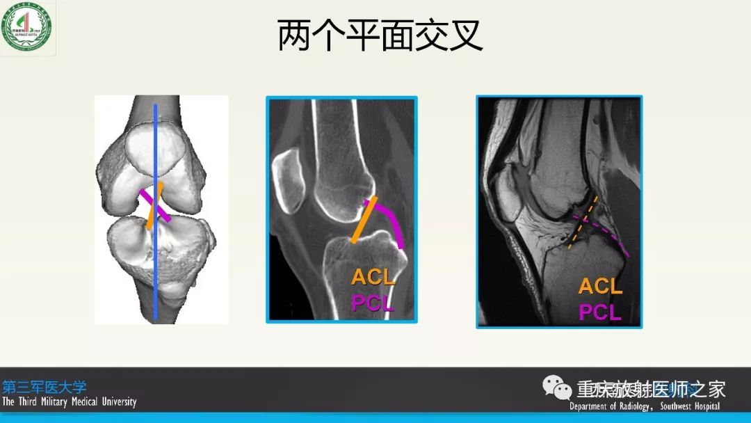 影像PPT - 【PPT】膝关节韧带MRI诊断要点-3
