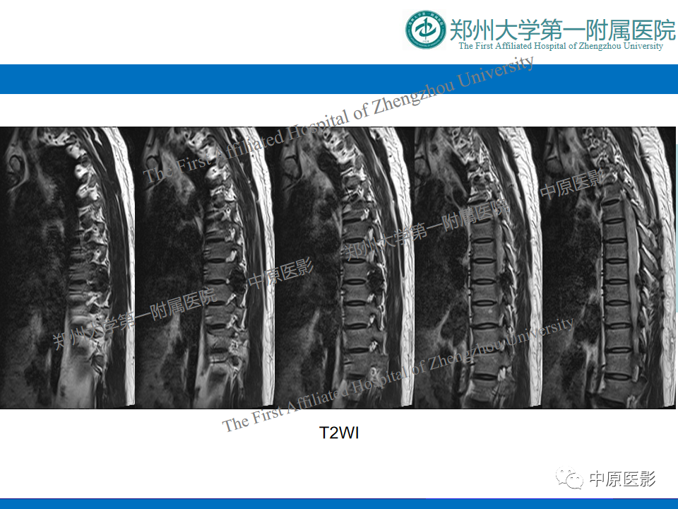 影像PPT - 【病例】脊柱胸椎腱鞘巨细胞瘤1例CT及MR-4
