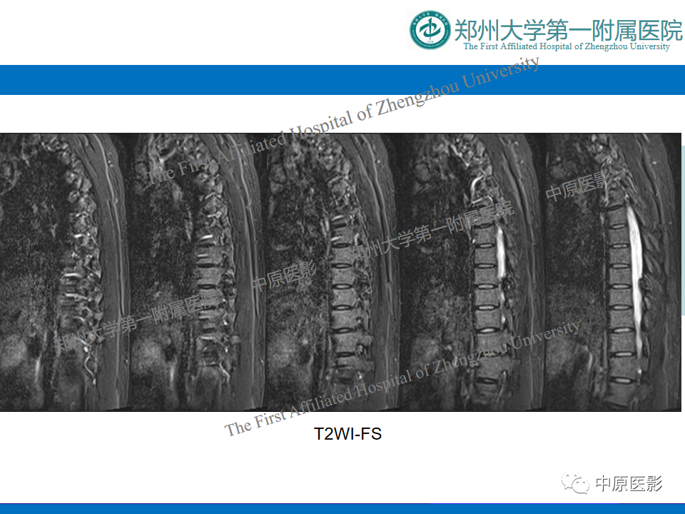 影像PPT - 【病例】脊柱胸椎腱鞘巨细胞瘤1例CT及MR-5
