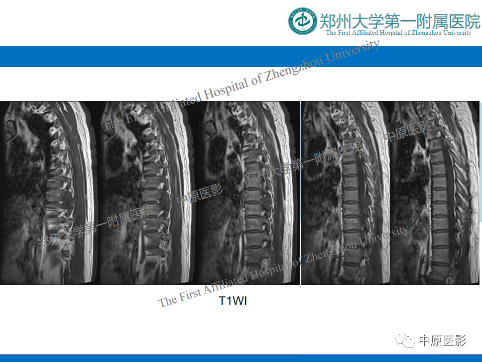 影像PPT - 【病例】脊柱胸椎腱鞘巨细胞瘤1例CT及MR-3