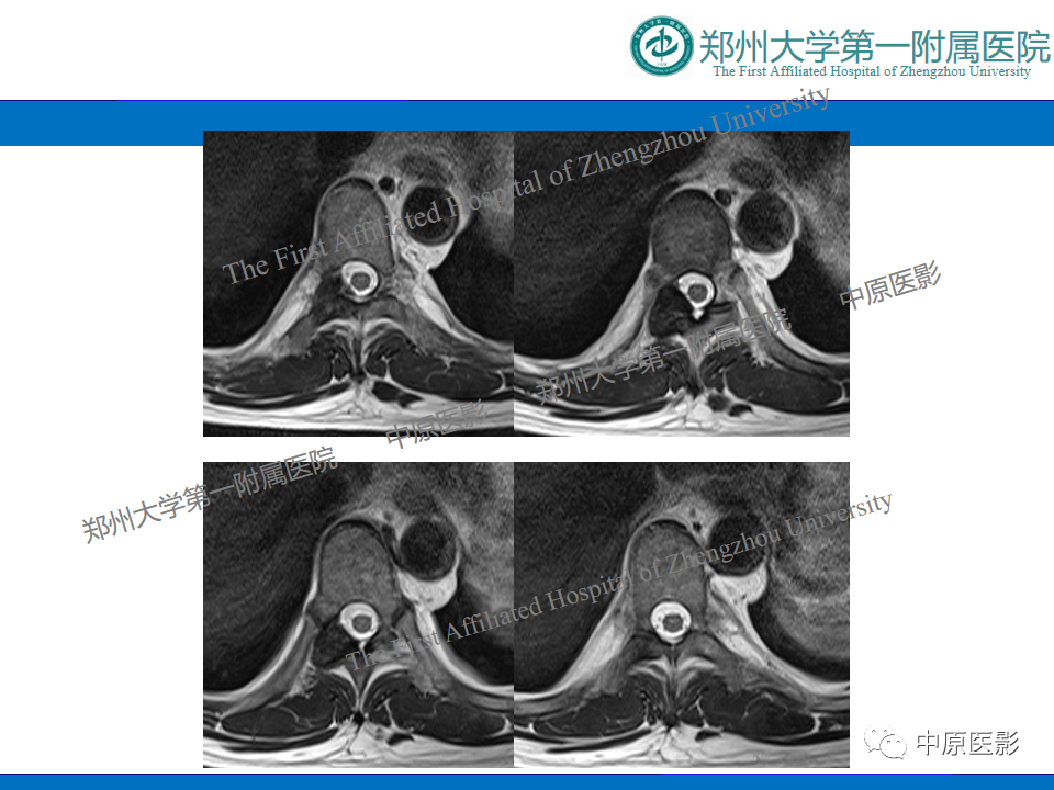 影像PPT - 【病例】脊柱胸椎腱鞘巨细胞瘤1例CT及MR-6