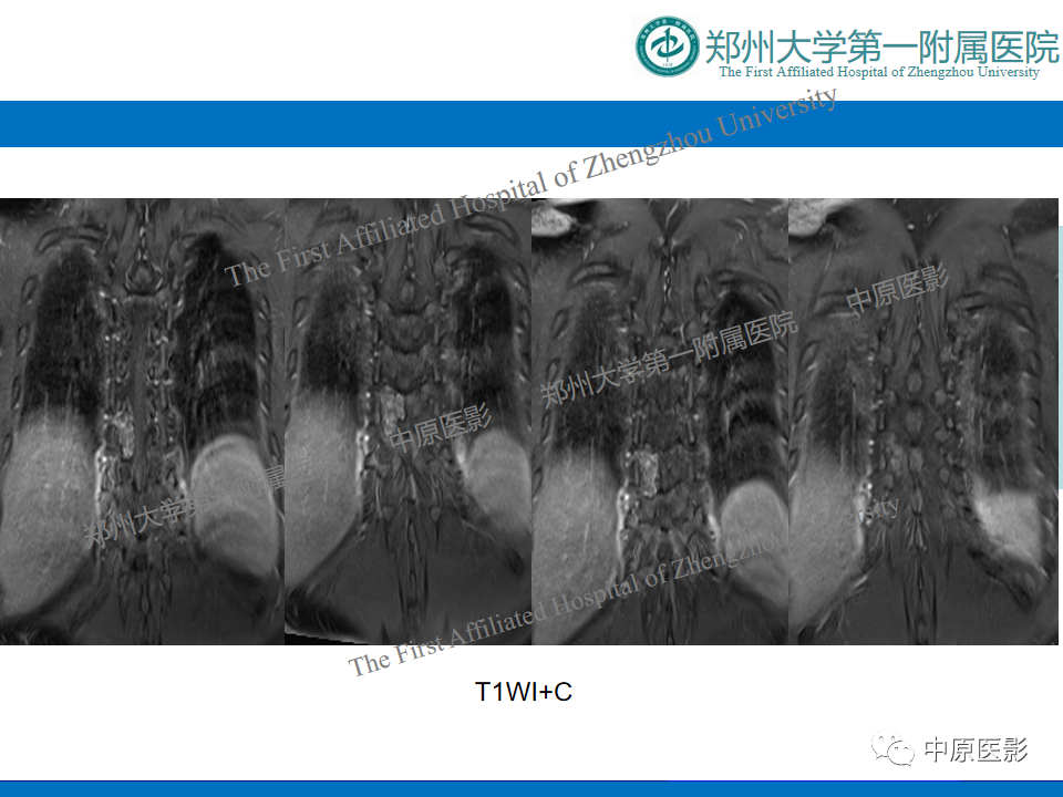 影像PPT - 【病例】脊柱胸椎腱鞘巨细胞瘤1例CT及MR-7