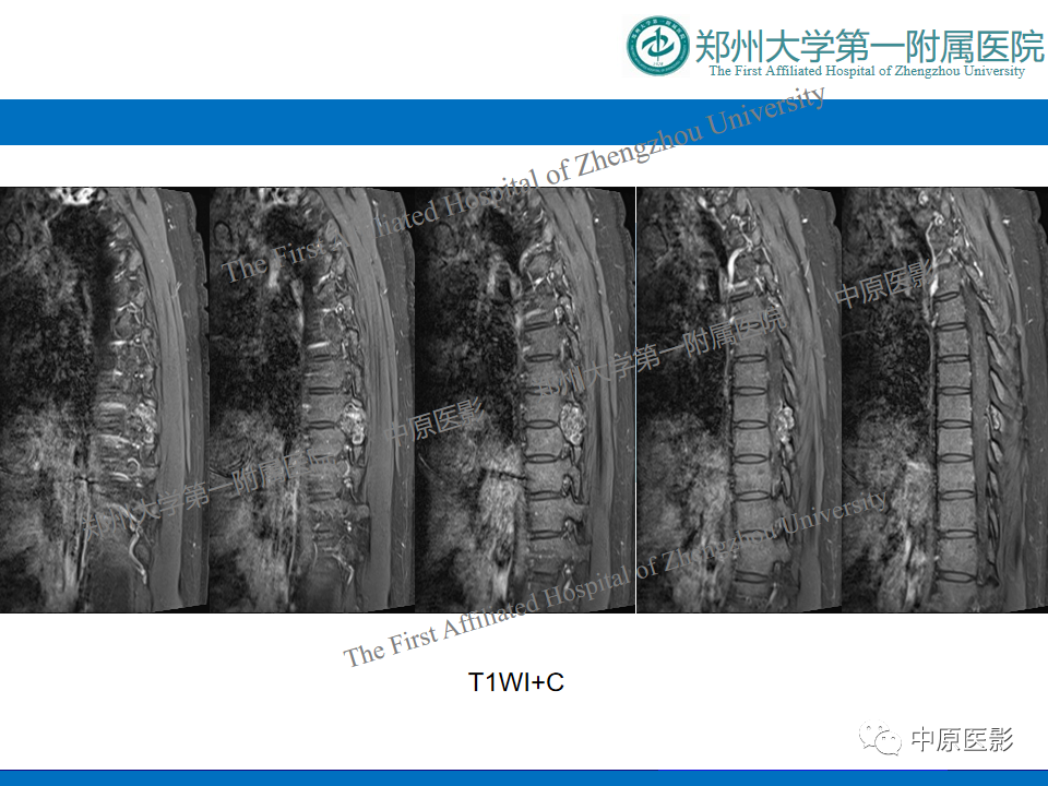 影像PPT - 【病例】脊柱胸椎腱鞘巨细胞瘤1例CT及MR-8