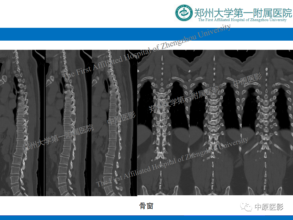 影像PPT - 【病例】脊柱胸椎腱鞘巨细胞瘤1例CT及MR-10
