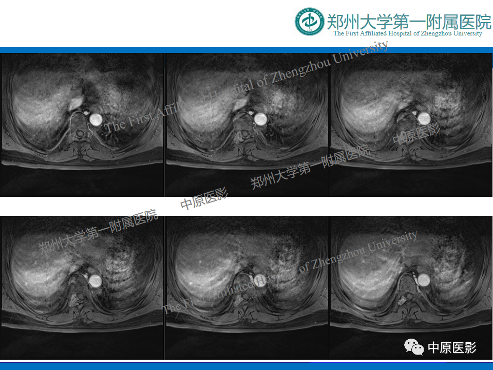 影像PPT - 【病例】脊柱胸椎腱鞘巨细胞瘤1例CT及MR-9